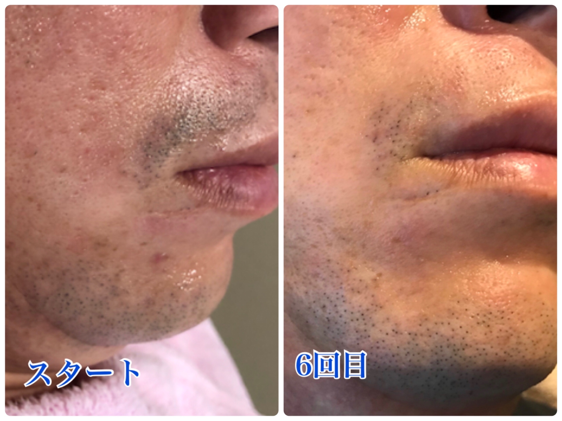 ひげ症例増えてます 香川県丸亀市 メンズ脱毛サロン メンズ7