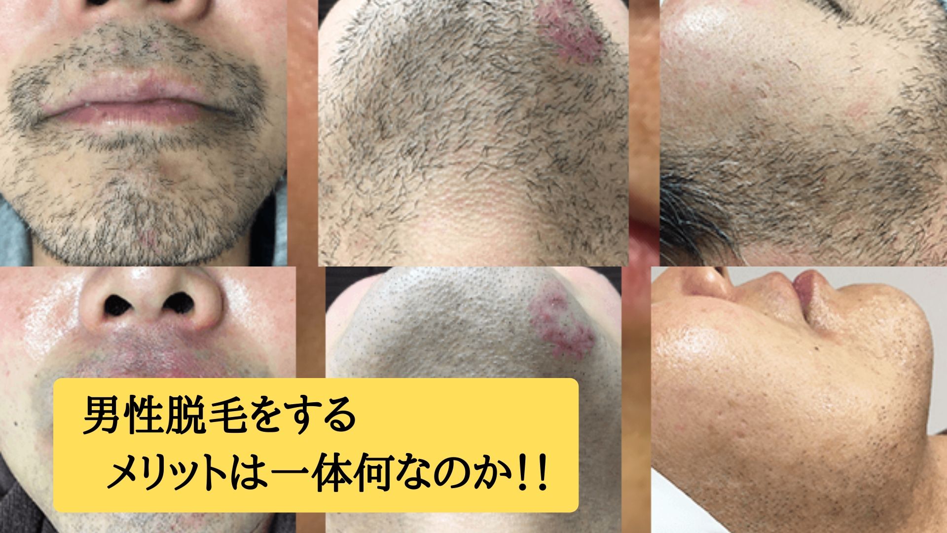 男性脱毛をするメリットは一体何なのか 香川県丸亀市 メンズ脱毛サロン メンズ7