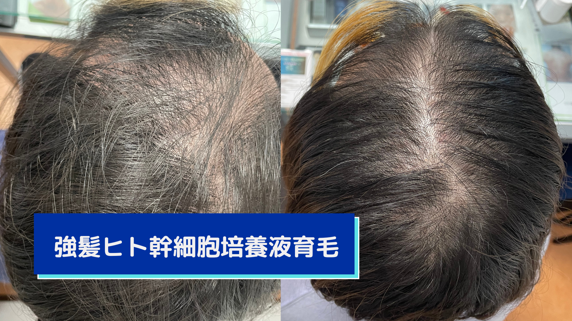 強髪ヒト幹細胞培養液育毛