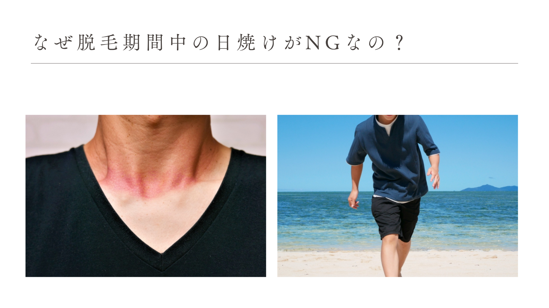 なぜ脱毛期間中の日焼けがNGなの?