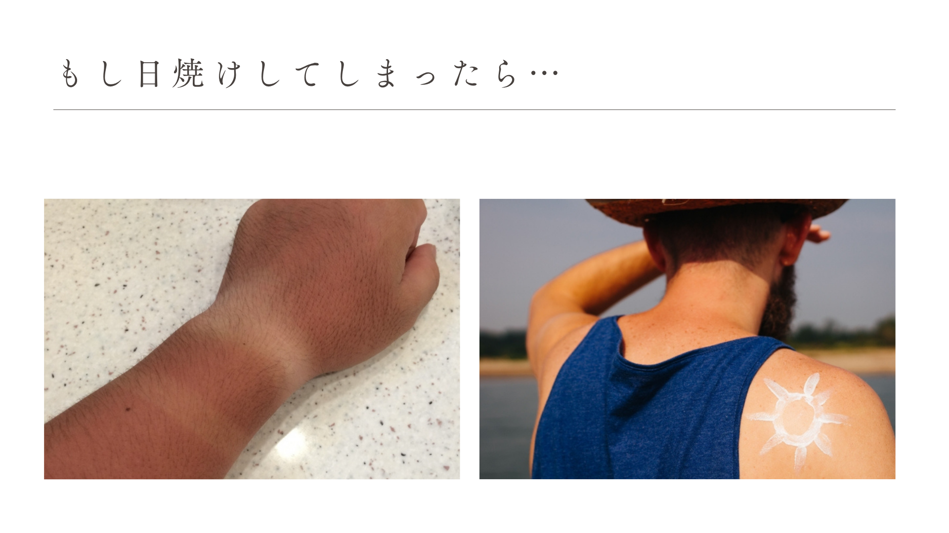 もし日焼けしてしまったら…