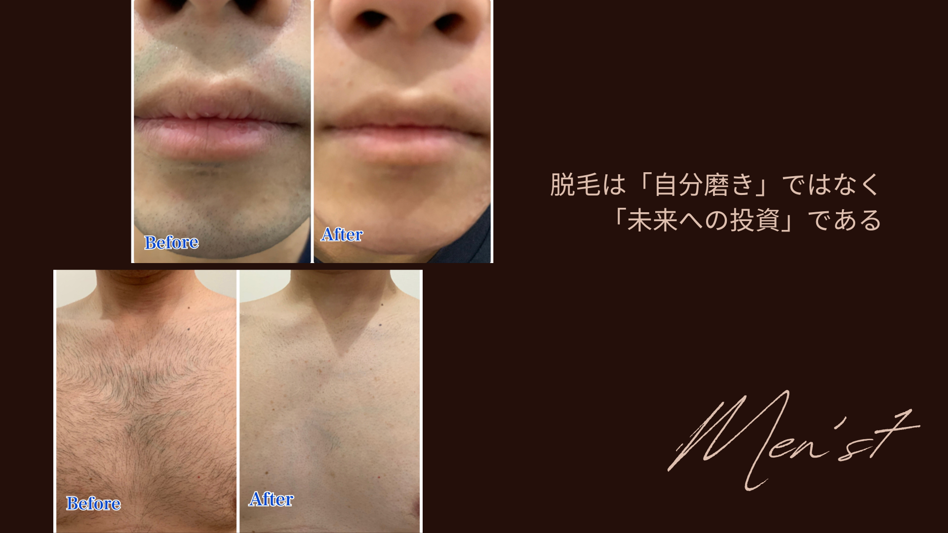 脱毛は「自分磨き」ではなく「未来への投資」である