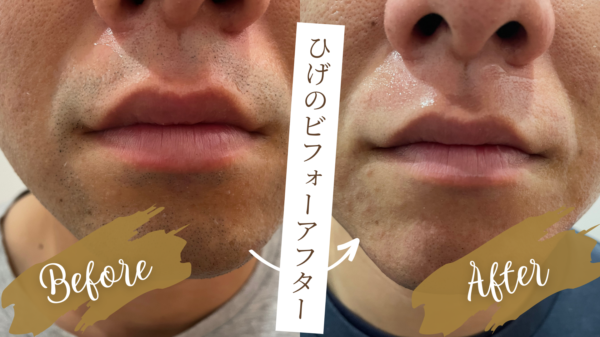 「ひげ脱毛」から始まる、男の劇的ビフォーアフター