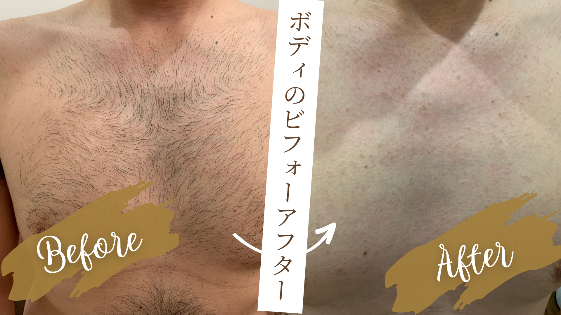 成功者が次々に「ボディ脱毛」をセットで始める理由